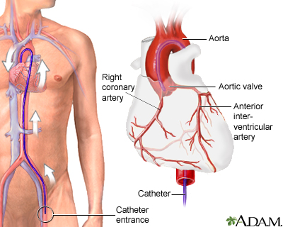 Medistate | Kalp Kateterizasyonu ve Anjiyografi